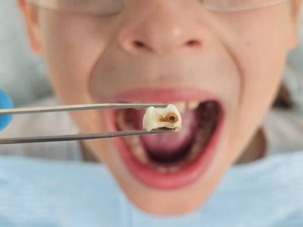 Best Emergency Dentist for Knocked-Out Tooth in Osborne, KS